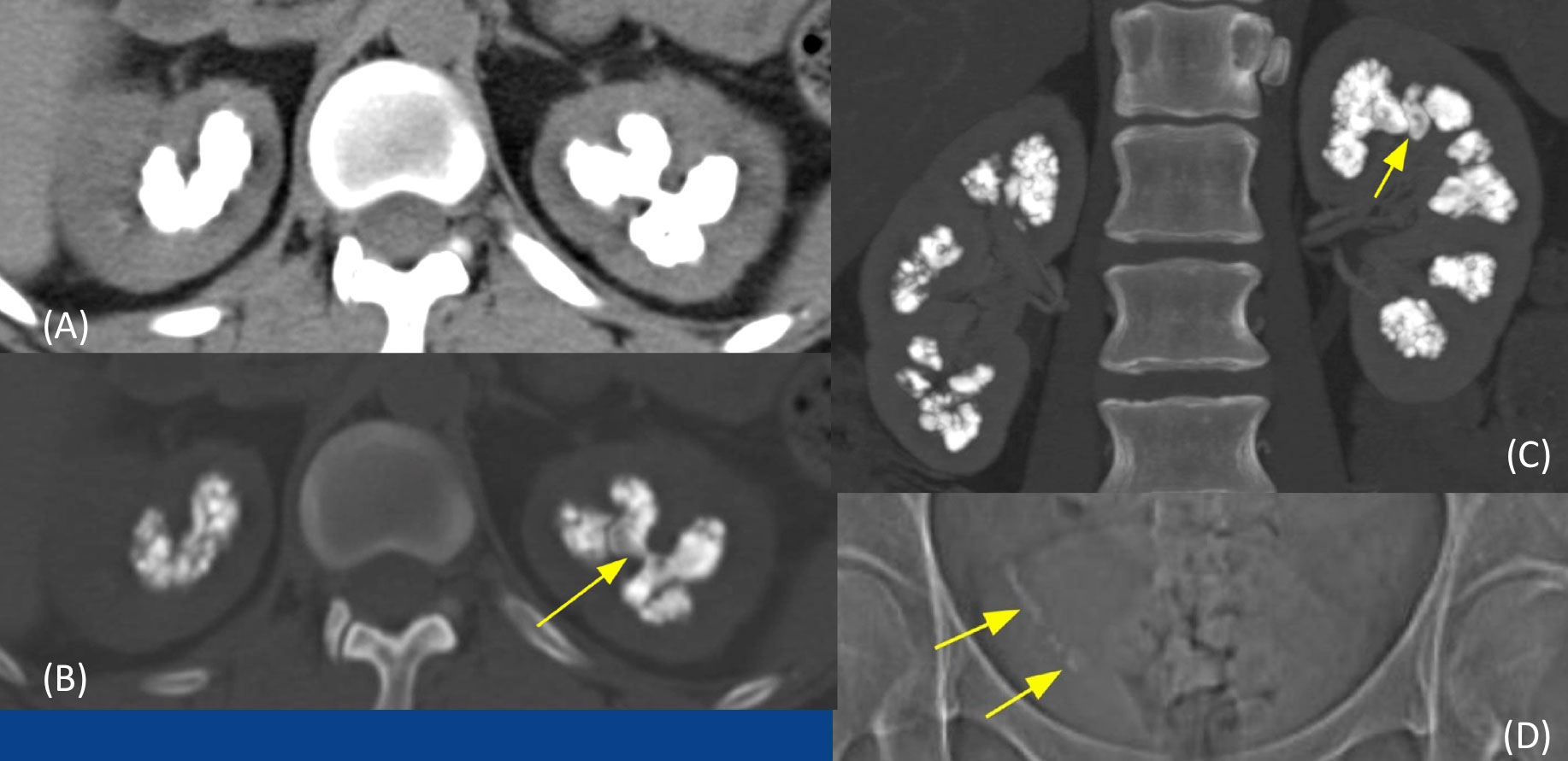 Medullary Nephrocalcinosis